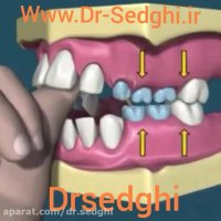 عوارض مکیدن انگشت