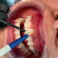 درمان لبخند لثه ای