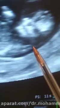 سونوگرافی NT جنین غیر نرمال