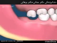 دندان عقل نهفته