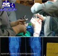 فیلم جراحی تعویض مفصل زانو در فرد جوان مبتلا به آرتریت