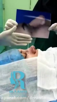 فیلم جراحی زیبایی بینی کاملا گوشتی