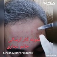 آموزش بوتاکس صورت☝