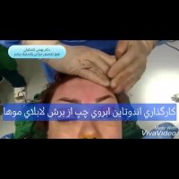 فیلم لیفت آندوسکوپیک ابرو با اندوتاین توسط پروفسور کشکولی | بهترین جراح پلک تهران