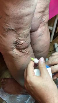 درمان واریس پیشرفته ران پا با اسکلروتراپی | دکتر توفیق متخصص واریس