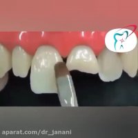 ترمیم دندان های شکسته با کامپوزیت ونیر