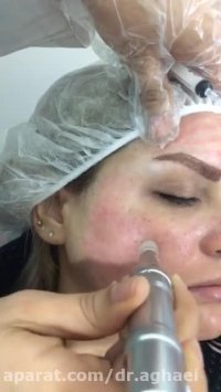 میکرونیدلینگ به همراه مزوتراپی ضد لک 2