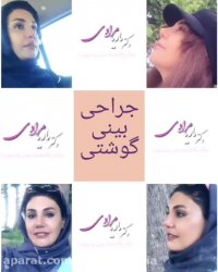 جراحی بینی گوشتی