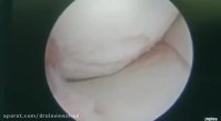 عوارض عدم بازسازی رباط صلیبی قدامی در افراد جوان و فعال .