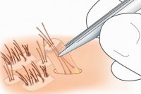 بانک مو در کاشت موی طبیعی