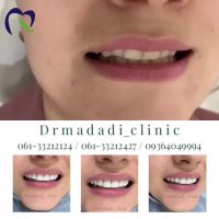 ونیر کامپوزیت در اهواز