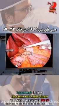 مینی بای پس در خانم 34 ساله