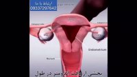 آندومتریوز چیست؟!!