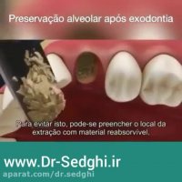 شکستگی ریشه دندان