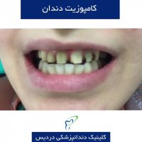 کامپوزیت دندان