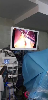 لایو اینستاگرام : جراحی چاقی بای پس کلاسیک ( ادامه از بای پس در خانم 33 ساله )