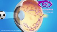 فیلم توضیحات دکتر پریسا اشترنخعی در مورد جراحی چشم
