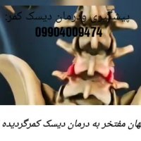 روش نوین درمان دیسک کمر(کارشناس:امیری)
