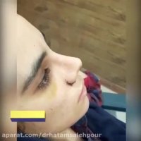 فیلم جراحی بینی