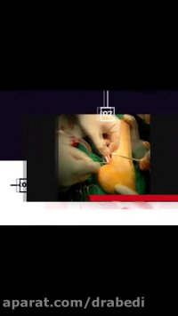 اصلاح کجی و دفورمیتی پا