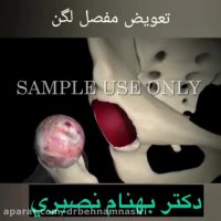 تعویض مفصل لگن چیست؟