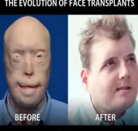 روند عمل پیوند صورت از سال 2005 تا 2015