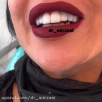 اصلاح طرح لبخند