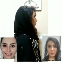 عمل بینی فانتزی عروسکی - نتیجه عمل بینی بعد از 3 ماه