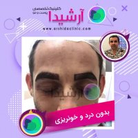 کاشت ابرو آقایان