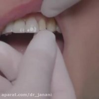 روكش زیبایی