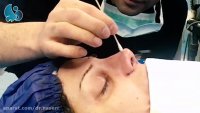 فیلم جراحی زیبایی بینی توسط دکتر مسعود ناصری صدر