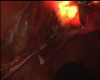 SecuFix Uterine Manipulator application video