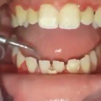 جرمگیری دندان-مرکز دندانپزشکی فوق تخصصی ایمپلنت پردیس www.pardisdental.ir