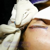 کاشت ابرو روش fut | کلینیک آیتک | 44228594-021