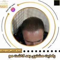 کاشت مو دائمی | کلینیک پایتخت | 44228594-021
