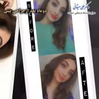 فیلم نتیجه جراحی بینی بعد از دو ماه