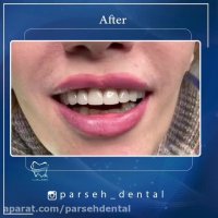 روکش سرامیکی دندان