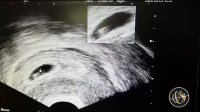 سونوگرافی هفته هفتم بارداری