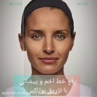 رفع خط اخم و پیشانی با تزریق بوتاکس | دکتر ماریا مرادی