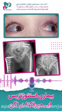 بیماری استئوژنزیس ایمپرفکتا در لگن