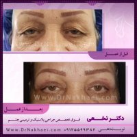 فیلم جراحی پلک فوقانی