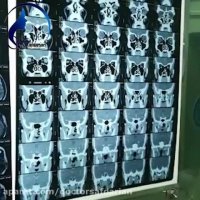 برداشتن تومور در آقای ۲۲ ساله