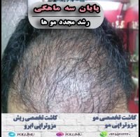 مراحل رشد مو بعد از کاشت مو