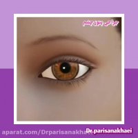 انیمیشن کوتاه از جراحی پتوز پلک