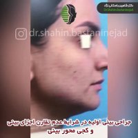 جراحی بینی اولیه با کجی محور بینی | دکتر باستانی نژاد