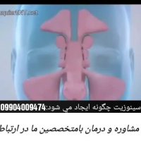 سینوزیت چگونه ایجاد می‌شود؟درمان این بیماری چیست؟