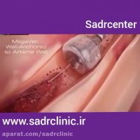 برداشتن لخته خون از رگ با انژیوگرافی