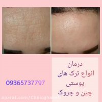 درمان قطعی کک و مک و رفع جوش و آکنه صورت؟؟