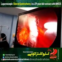 جراحی اسلیو معده در خانم 29 ساله