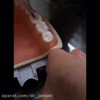 ترمیم همرنگ دندان